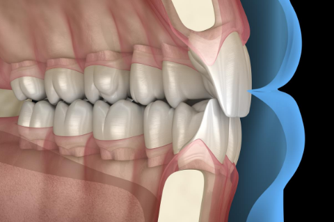 occlusione dentale