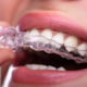 Denti mancanti: conseguenze e soluzioni