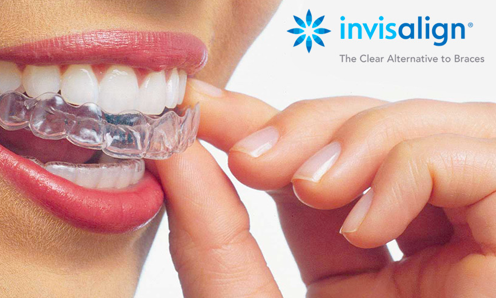 invisalign