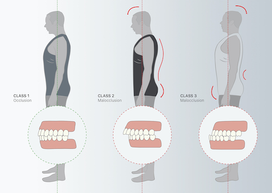 malocclusione dentale