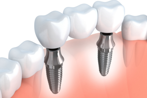denti mancanti