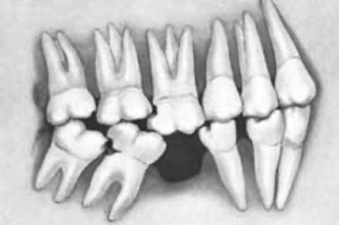 Correlazioni tra mancanza di denti e mal di schiena